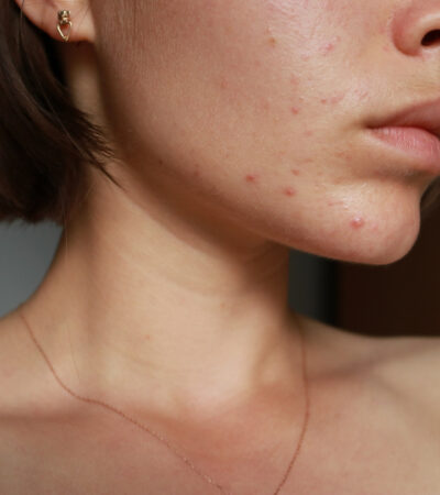 A Woman’s Wellness Expert Shares 5 Tips To Reduce Hormonal Acne